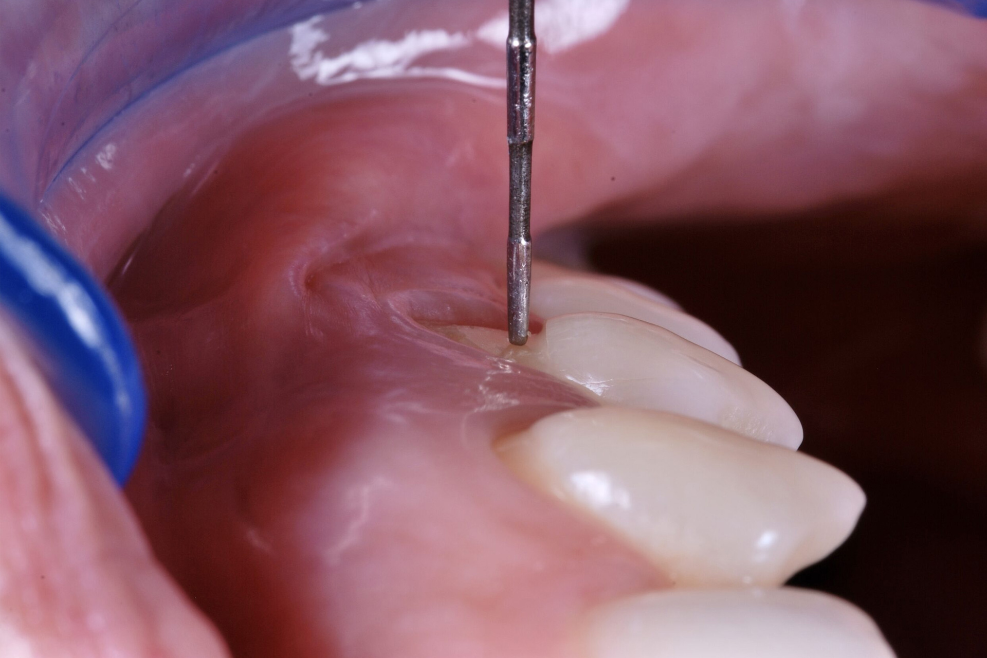 Chirurgia Mucogengivale