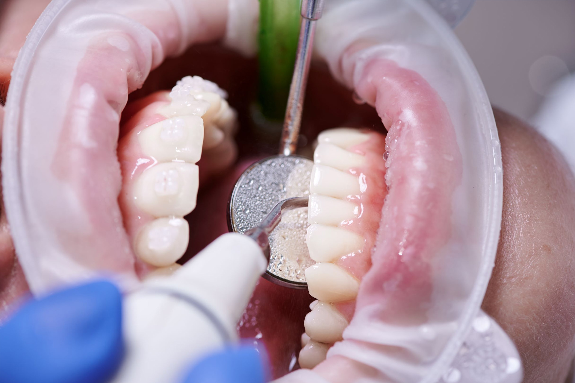 Chirurgia Parodontale