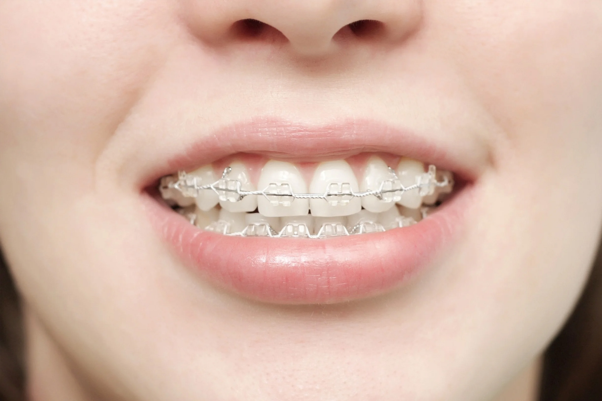 Ortodonzia Intercettiva