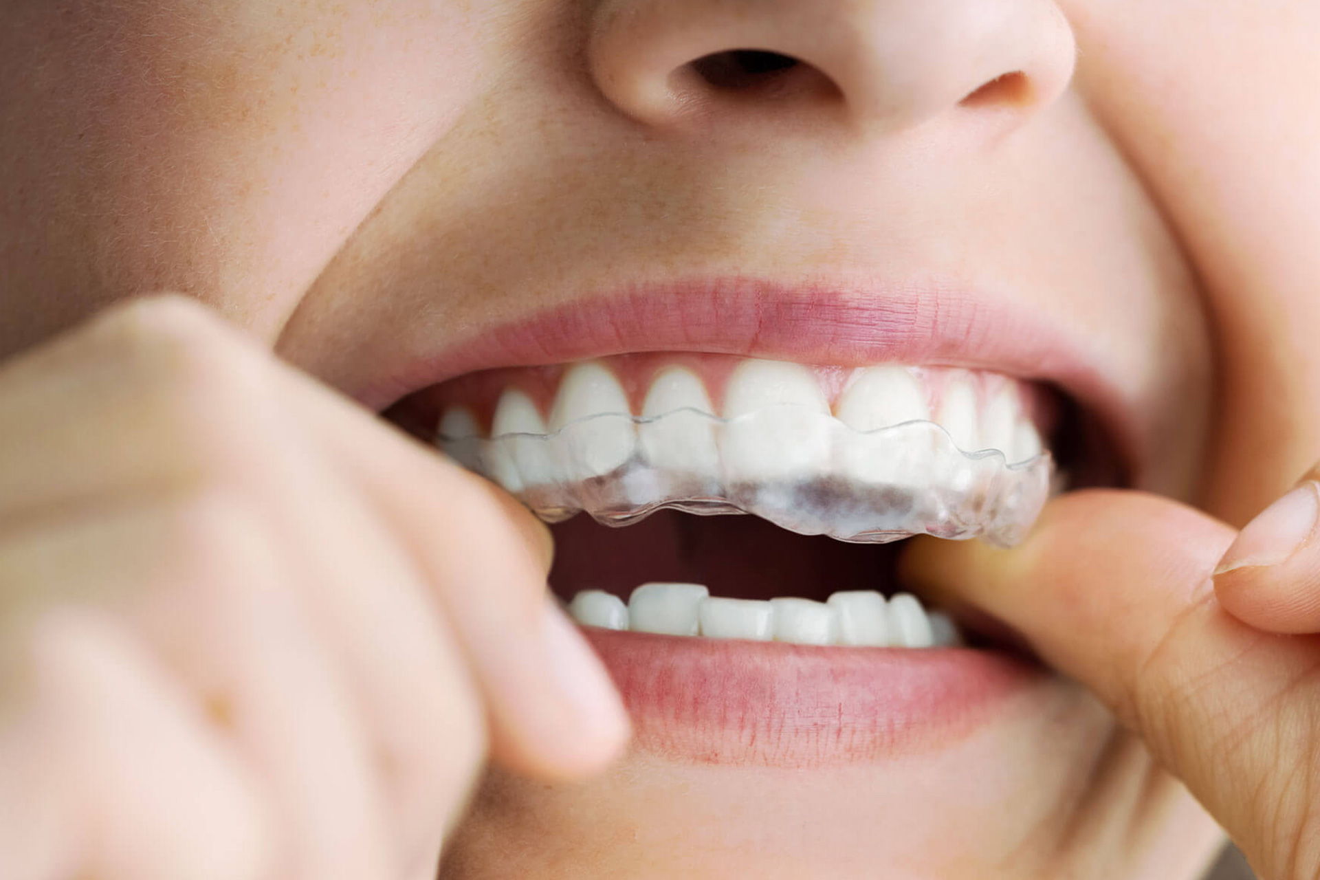 Ortodonzia Invisibile